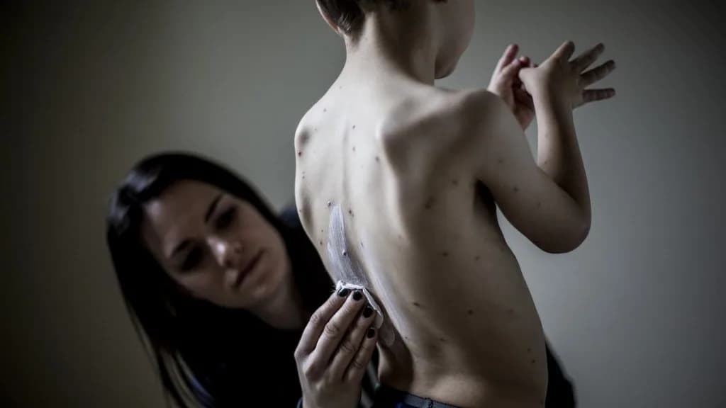 Bárányhimlő után kapott stroke-ot egy négyéves kisfiú