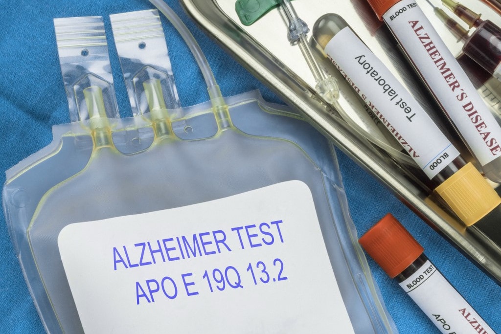 Döbbenet, a fogorvosnál is el lehet kapni az Alzheimer-kórt