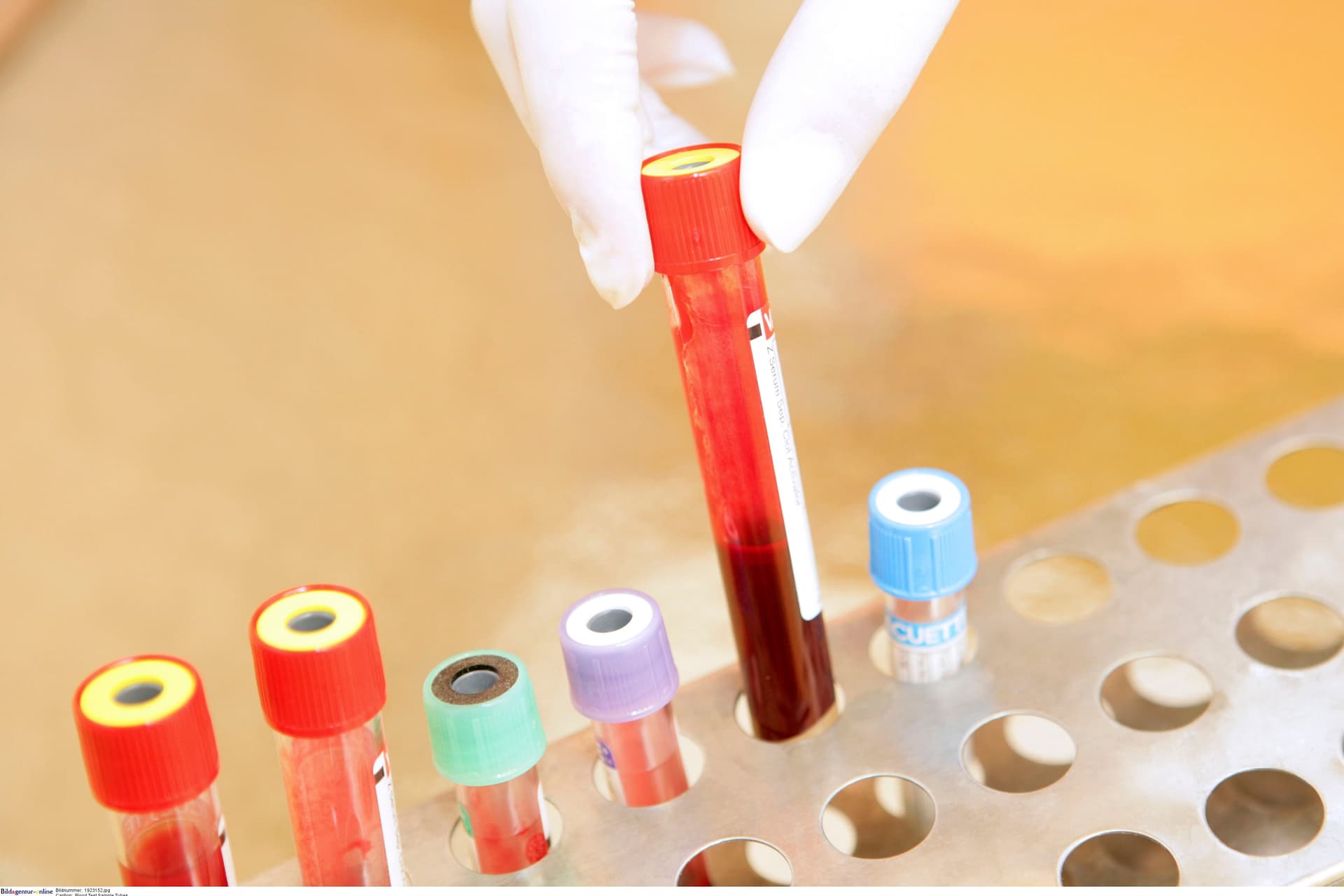 Már a harmadik HIV-beteget nyilvánították gyógyulttá az őssejtterápiának hála