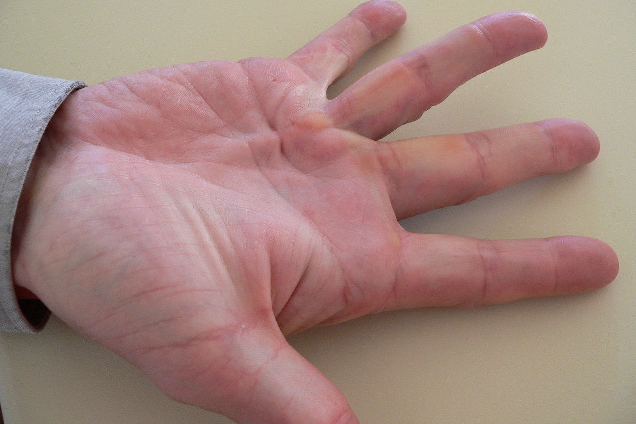 A „viking betegség”