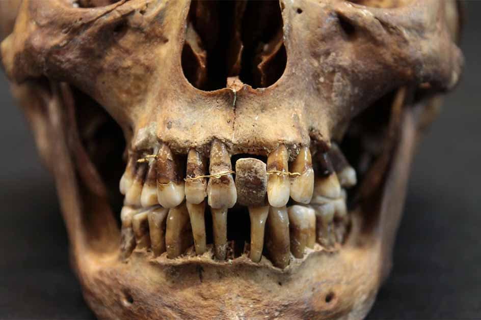 Ennek a 17. századi arisztokratának volt egy ravasz titka a fogai megőrzésére