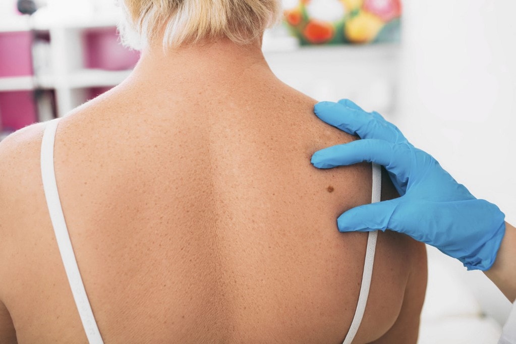 Dermatológusok: két évtized alatt megduplázódott a magyarországi bőrrákos esetek száma