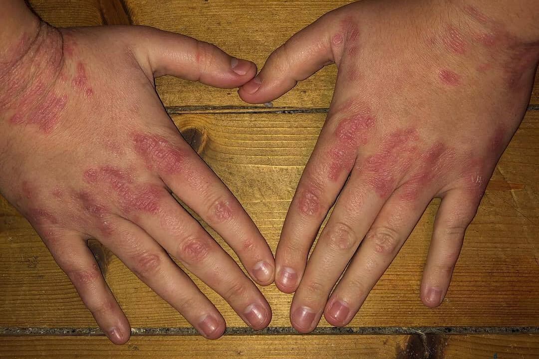 Dermatológiai társulat: A pikkelysömörre ma már van korszerű terápiás lehetőség