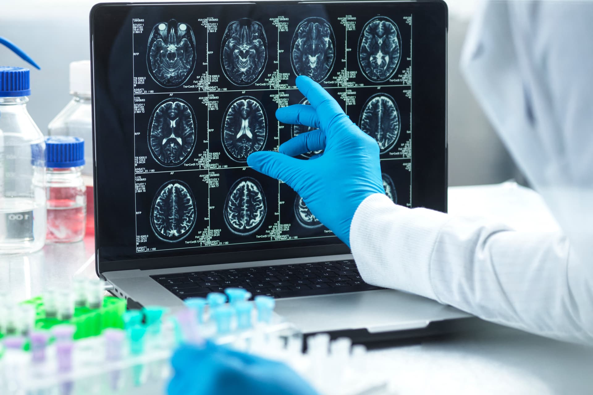 Hihetetlen felfedezés: hamarosan gyógyítható lesz a stroke