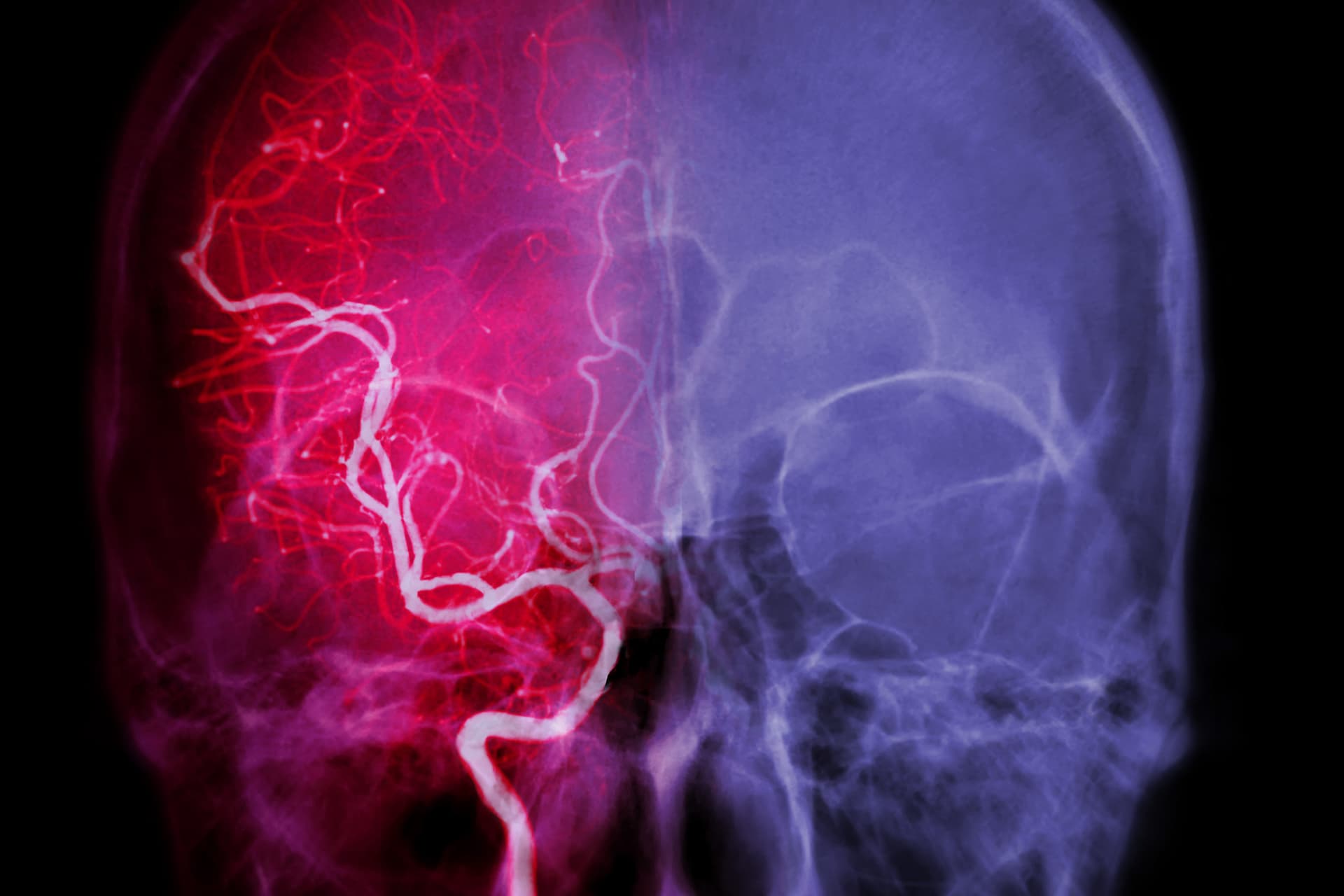 Így ismerhetjük fel a stroke-ot