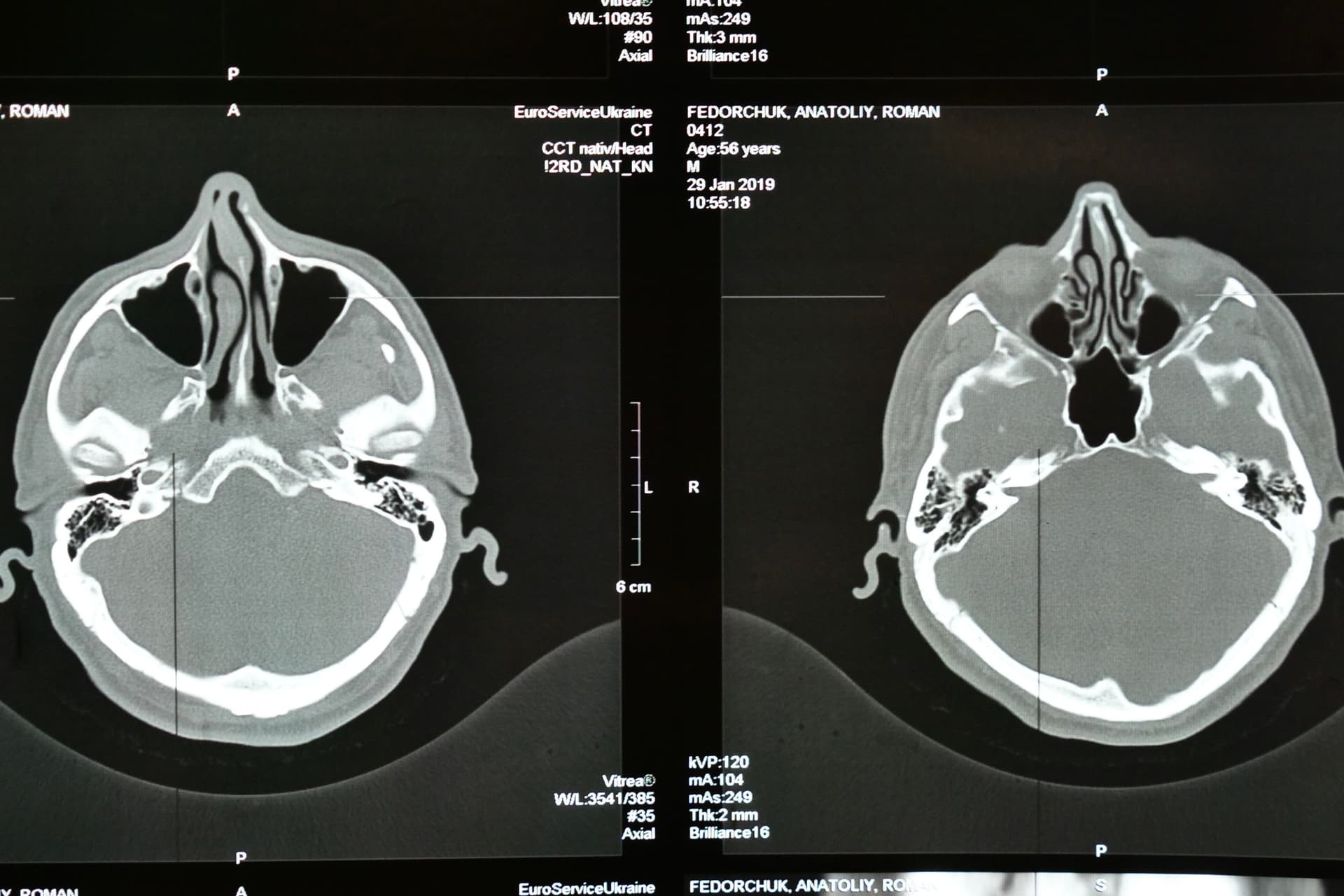 A stroke három legfontosabb kockázati tényezője